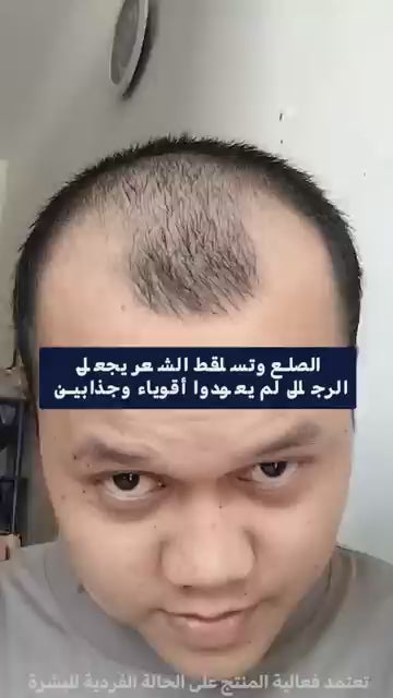 بخاخ إنبات الشعر بلس — نتائج خلال 14 يومًا  Hair Growth Spray PLUS — Results in 14 Days